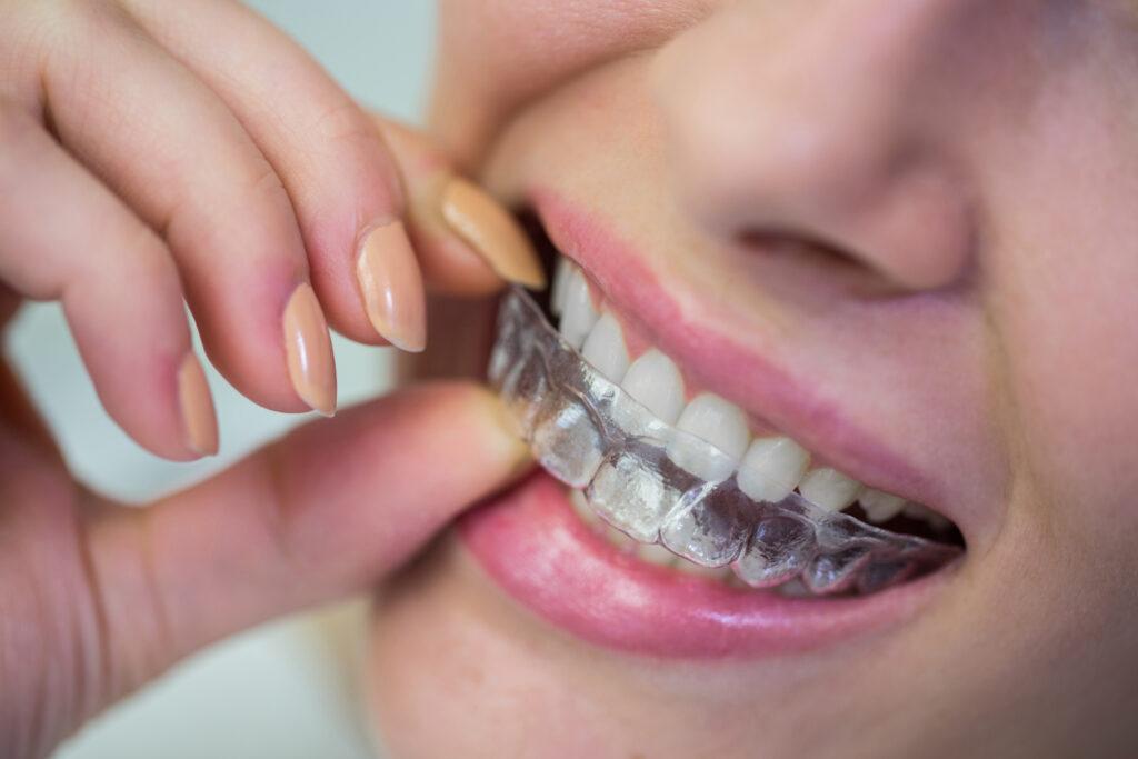 Invisalign Cost  Singapore 